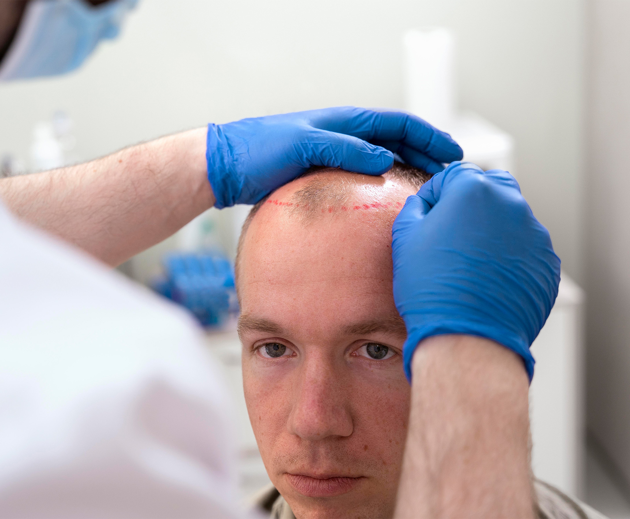 Bald Patches Correction