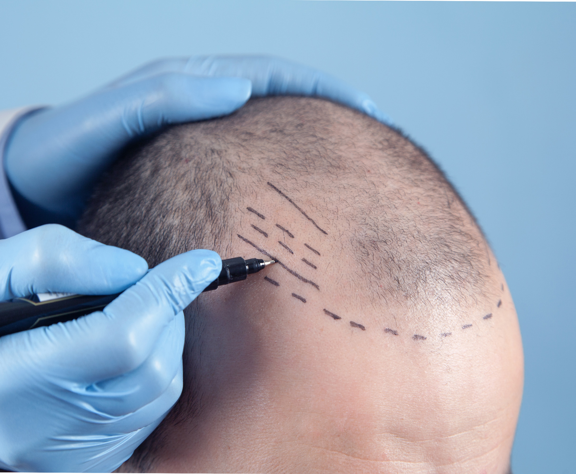Edge Enhance Hairline Correction