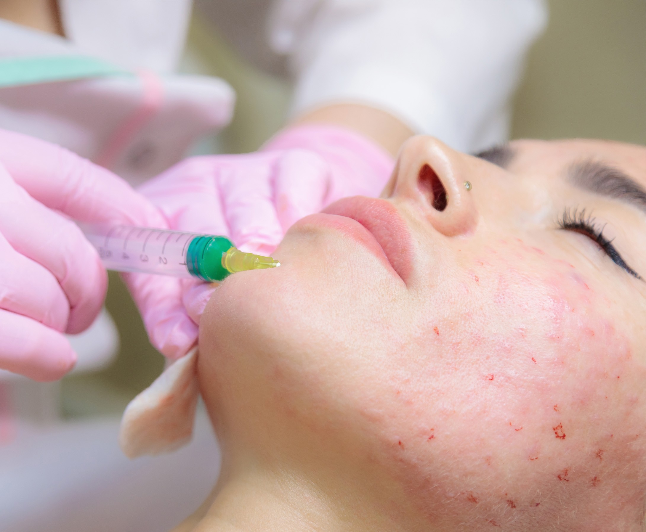 Blemish Buster Acne Treatment